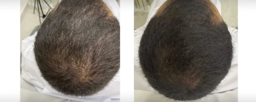 PRP (Platelet-Rich Plasma) Treatment