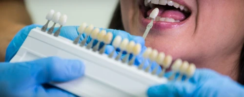Dental Implants