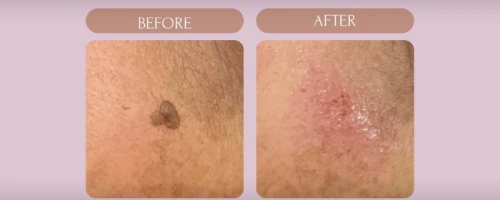 Removal of Moles and Skin Tags