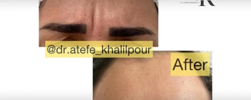 Botox Injection