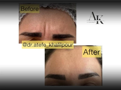 Botox Injection