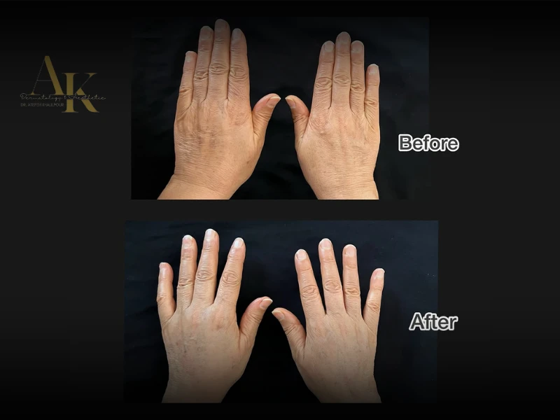 Skin Rejuvenation