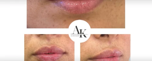 Lip Filler Injection