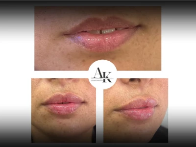 Lip Filler Injection